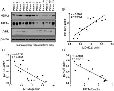 MDM2 promotes cancer cell survival through regulating the expression of HIF-1α and pVHL in retinoblastoma